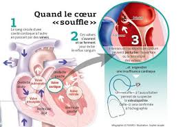 En effet, la prévalence de l'insuffisance cardiaque est estimée à 2.3% en france et malgré une prise en charge améliorée, la mortalité associée à. De Plus En Plus De Malades Atteints De Valvulopathies