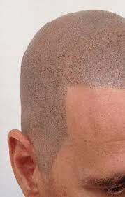 In sostanza con questa tecnica si . Tricopigmentazione Come Funziona Il Tatuaggio Dei Capelli