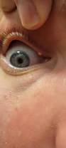 Image result for milium cyst on eyelid