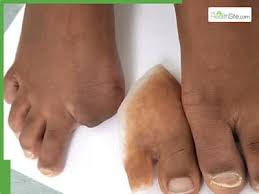 Image result for toe amputation