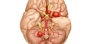 Most people with brain aneurysms have no symptoms. Rupture Rates For Small Brain Aneurysms Top Neuro Docs