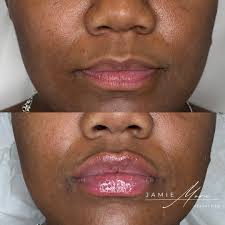 Schedule your appointment with Jamie Mora, PA-C @Studiophilly Link in bio  267-586-4978 Hablo Español 🇨🇴 Treatments/Pricing -SKINVIVE