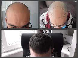 Il trapianto di capelli impone, come tutti gli interventi, alcune regole da. Trapianto Capelli Risultati Dopo 3 O 6 Mesi Elithair