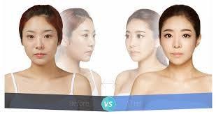 Cheek Reduction Surgery Cheek Implants Plastic Surgery Reduction Surgery