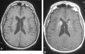 Image result for Cryptococcal Meningitis