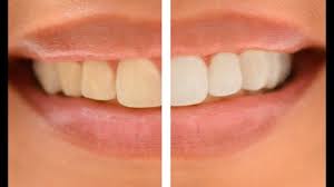 Photoshop elements makes it easy to do and you can control exactly how much whitening to apply as you get feedback on your monitor. How To Whiten Teeth In Photoshop Two Steps Youtube