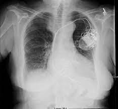 Classification follows pacemaker code developed by the north american society of pacing and dual chamber pacing. Chest X Ray Indicates Biventricular Icd Dual Chamber Pacemaker Arrow Download Scientific Diagram