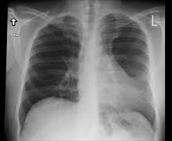 There is some loculated pleural fluid posterolateral as a. Poland Syndrome Radiology Case Radiopaedia Org