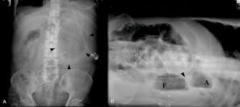 The shunt flow was exacerbated by postural changes from the left to the right lateral decubitus. Delayed Diagnosis Of Intermittent Mesenteroaxial Volvulus Of The Stomach By Computed Tomography A Case Report Journal Of Medical Case Reports Full Text
