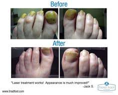 Also known as tinea pedicle, it means fungus infection on your fingers and feet. 16 Foot Fungus Ideas Toenail Fungus Foot Fungus Athletes Foot