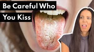 Image result for Oral thrush roof of mouth
