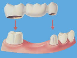Dental Bridges Cost Types Procedure