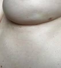 Esta Foto Viral Revela El Sintoma Del Cancer De Mama Que Quizas No Conoces