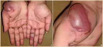 Image result for Fixed Drug Eruption