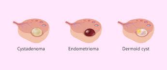 Image result for Cyst