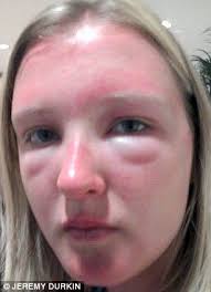 Food Allergy Redness Swelling Food Allergies Awareness Undereye Redness