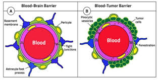 Glioblastoma mutiforme (gbm), a lethal brain tumor. Tailored Nanocarriers And Bioconjugates For Combating Glioblastoma And Other Brain Tumors