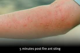 Image result for ant bite