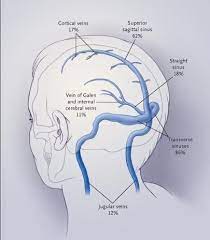 Find what is a thrombosis right now at options.xyz! Como Identificar La Trombosis Venosa Cerebral Noticias Medicas Intramed