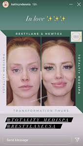 Kathryn Dennis Shows Lip Filler, Newtox, CoolSculpting Results