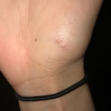 Image result for spinne biss haut reaktion