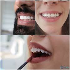 صور لنتائج ابتسامة هوليود في تركيا نفذت في عيادتنا Dentcenterturkey