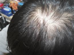 Hair loss may also be genetic. Am I Thinning On The Crown I Wanna Hear Your Opinions Bald