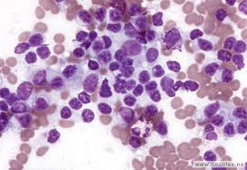 Ifølge national kidney og urologiske diseases information clearinghouse, kan årsaker til. Utredning Ved Leukemi