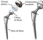 Artroplastia total de quadril (Total Hip Replacement ...