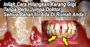 Tak Payah Jumpa Doktor Inilah Cara Senang Berkesan Nak Hilangkan Karang Gigi Anda Ternyata Viral