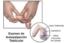 Pequena Bolita En El Testiculo Derecho
