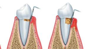 Image result for Gingivitis