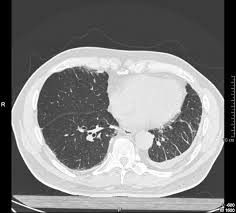 Consequently, pleural changes (eg, plaques, malignant mesothelioma) will manifest at. Clinical Consequences Of Asbestos Related Diffuse Pleural Thickening A Review Journal Of Occupational Medicine And Toxicology Full Text