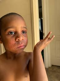 What to do when child has fever and starts aba school?