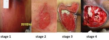 Maybe you would like to learn more about one of these? 67 Pressure Ideas Pressure Ulcer Ulcers Pressure