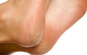 Are you afraid it might be the cause of your symptoms? Psoriatic Arthritis Symptoms