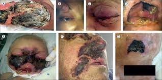 Mucormicosis • descrita por platauf en 1885 al encontrarse con un cuadro de micosis mucorina • no se lograba aislar al agente, debido a las características morfológicas de los filamentos observados. Global Guideline For The Diagnosis And Management Of Mucormycosis An Initiative Of The European Confederation Of Medical Mycology In Cooperation With The Mycoses Study Group Education And Research Consortium The Lancet