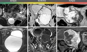 Gynakologische Tumoren Im Kleinen Becken Springerlink