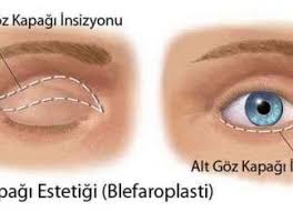 Goz Kapagi Dusuklugu Ameliyati Gozler Saglik Rehber