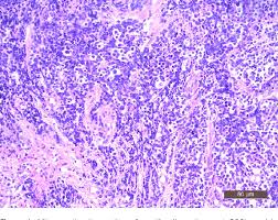 This is a dangerous disease that can cause breathing difficulties and ultimately. Pdf Small Cell Carcinoma Of The Endometrium A Clinicopathological And Immunohistochemical Study Semantic Scholar