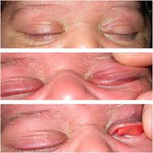 Image result for Eyelid Closure Defect