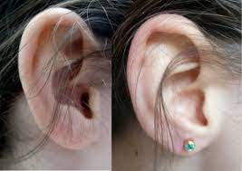 Sale Cleaning Newly Pierced Ears Is Stock
