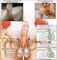 Penile Pump Placement for the Inflatable Penile Prosthesis - Alarcon - 2013  - The Journal of Sexual Medicine - Wiley Online Library