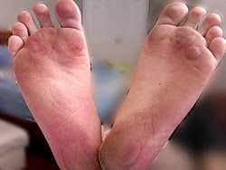 Leaving the affected spot alone is the best course of treatment. Blister Wikipedia