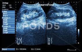 Ultrasonography Of Kidney Show Left Kidney Stone 2 Image For Compare Stock Photos Ad Show Left Ul Kidney Stones Business Card Templates Download Image