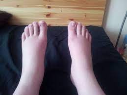 Mes pieds sont enflés, ainsi que mes chevilles et mes mollets. 7 Raisons Pour Lesquelles Vous Avez Les Pieds Gonfles Et Comment Y Remedier Therapeutes Magazine