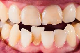 Baking soda can remove plaque without damaging the enamel. Things To Know About Dental Tartar Removal
