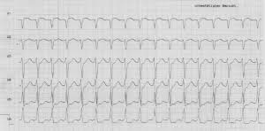 This video demonstrates the treatment of a patient with supraventricular tachycardia (svt) using adenosine. Das Ist Ja Umwerfend News Papers