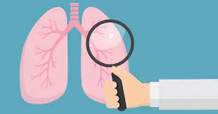 If you like this animation, like us on facebook: Should I Get A Lung Cancer Screening Cedars Sinai