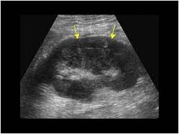 Perirenal Abscess Longitudinal Reproductive System Urinary Tract Renal